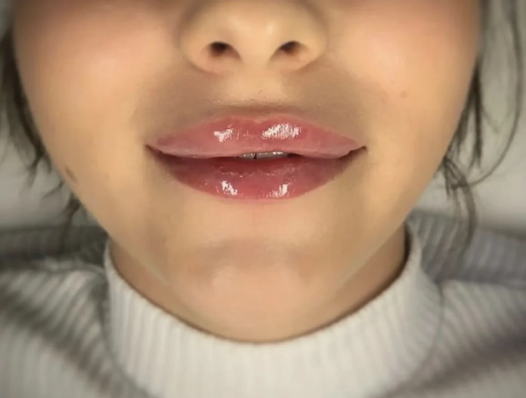 Harry Crowder | What Happens If You Smoke After Getting Your Lips Done? lip blush colors